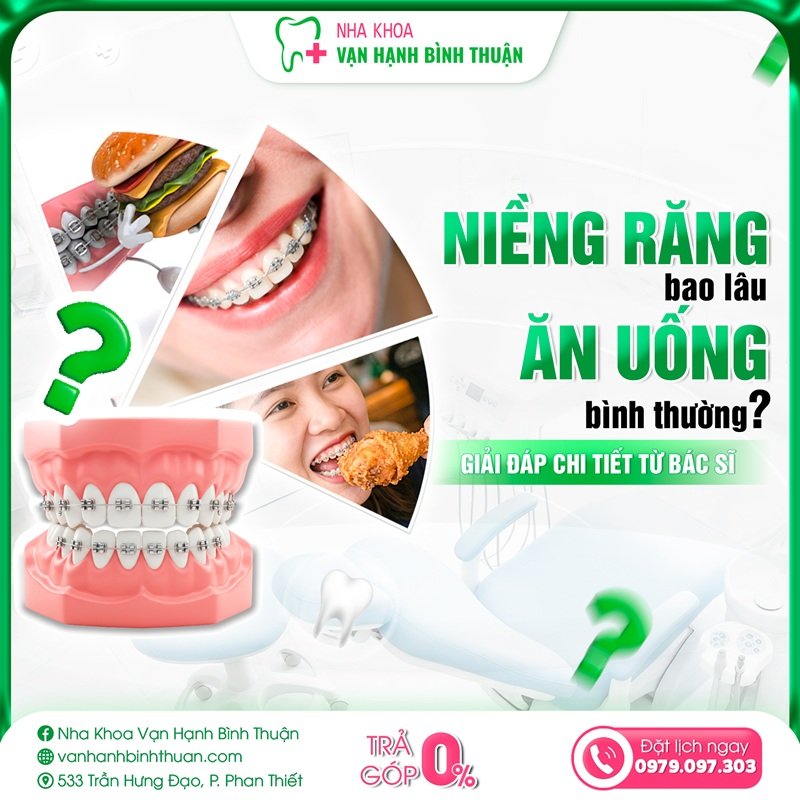 Niềng răng bao lâu ăn uống bình thường? Giải đáp chi tiết từ bác sĩ